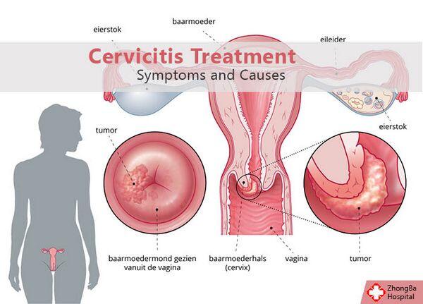 Cervicite