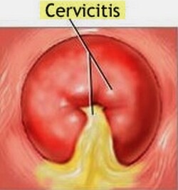 Cervicite