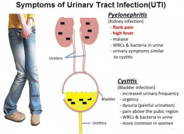 Sintomi dell'infezione delle vie urinarie